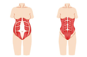 Rectus diastase ikon