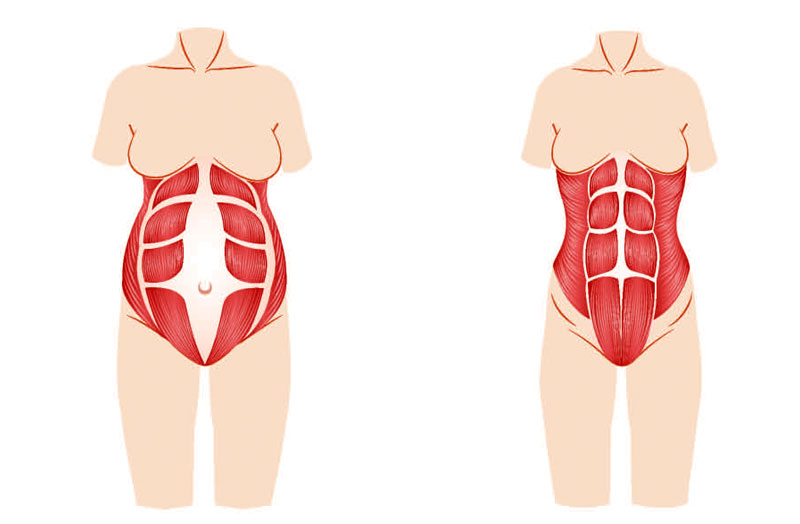 Сильные мышцы живота. Тейпирование диастаза. Мышцы живота. Ослабление мышц живота.