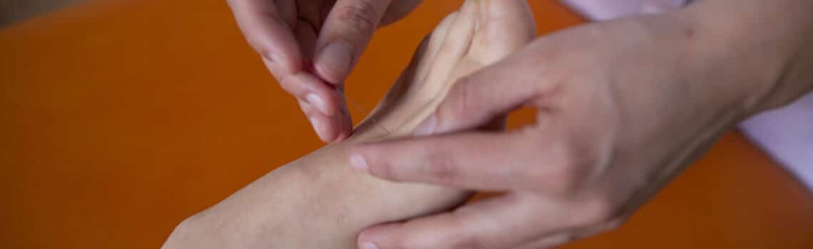 Akupunktur hos Bjøreng Klinik